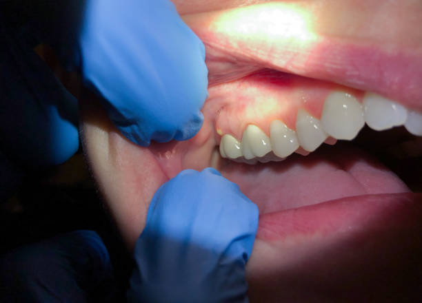 Best Dental Abscess Treatment in Baxter Village, SC