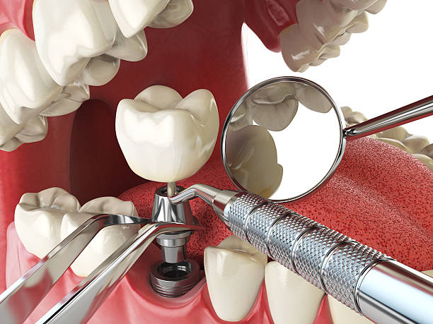 Best Emergency Wisdom Tooth Extraction in Baxter Village, SC